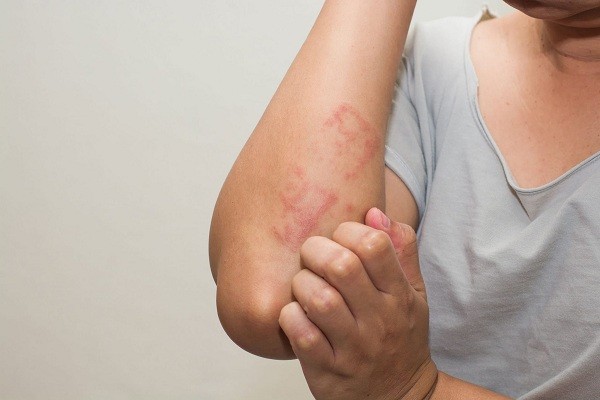 Kenali Bahan Alami Untuk Kulit Gatal Akibat Alergi